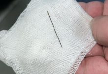 Photo of 8 АЙЛЫҚ СӘБИДІҢ ІШ ҚУЫСЫНАН ИНЕ ТАБЫЛДЫ